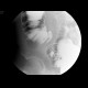 Appendix, appendicolith: RF - Fluoroscopy