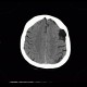 Arachnoid cyst, frontal lobe: CT - Computed tomography