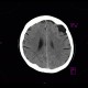 Arachnoid cyst, frontal lobe: CT - Computed tomography