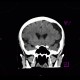Arachnoid cyst, frontal lobe: CT - Computed tomography