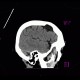 Arachnoid cyst, frontal lobe: CT - Computed tomography