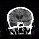 Arachnoidal cyst: CT - Computed tomography