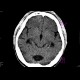 Arrested hydrocephalus: CT - Computed tomography