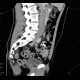 Artificial mass in the coecum: CT - Computed tomography