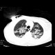 Atypical pneumonia: CT - Computed tomography