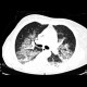 Atypical pneumonia: CT - Computed tomography