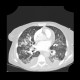 Atypical pneumonia, Pneumocystis pneumonia, PCP: CT - Computed tomography