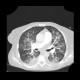 Atypical pneumonia, Pneumocystis pneumonia, PCP: CT - Computed tomography