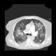 Atypical pneumonia, Pneumocystis pneumonia, PCP: CT - Computed tomography