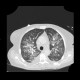 Atypical pneumonia, Pneumocystis pneumonia, PCP: CT - Computed tomography