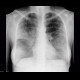 Atypical pneumonia, second case: X-ray - Plain radiograph