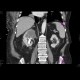 Renal cell carcinoma, atypical: CT - Computed tomography