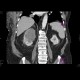 Renal cell carcinoma, atypical: CT - Computed tomography