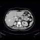 Hemangioma, cavernous hemangioma: CT - Computed tomography