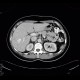 Hemangioma, cavernous hemangioma: CT - Computed tomography