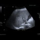 Hemangioma, cavernous hemangioma: US - Ultrasound