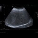Hemangioma, cavernous hemangioma: US - Ultrasound