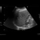 Hemangioma, cavernous hemangioma: US - Ultrasound