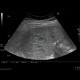 Hemangioma, cavernous hemangioma: US - Ultrasound