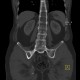 Ankylosing spondylitis, Bechterew's disease, Crohn's disease: CT - Computed tomography