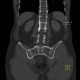 Ankylosing spondylitis, Bechterew's disease, Crohn's disease: CT - Computed tomography