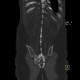 Ankylosing spondylitis, Bechterew's disease, Crohn's disease: CT - Computed tomography