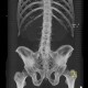 Ankylosing spondylitis, Bechterew's disease, Crohn's disease: CT - Computed tomography