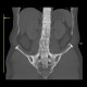 Ankylosing spondylitis, Bechterew's disease, Crohn's disease: CT - Computed tomography