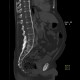 Ankylosing spondylitis, Bechterew's disease, Crohn's disease: CT - Computed tomography