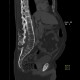 Ankylosing spondylitis, Bechterew's disease, Crohn's disease: CT - Computed tomography