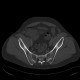 Ankylosing spondylitis, Bechterew's disease, Crohn's disease: CT - Computed tomography