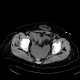 Biloma, complication of biliary drainage, PTC: CT - Computed tomography
