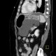 Biloma, complication of biliary drainage, PTC: CT - Computed tomography