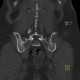Bone defect after bone graft harvest: CT - Computed tomography