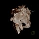 Bone defect after bone graft harvest: CT - Computed tomography