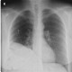 Diaphragmatic hernia, Morgagni hernia: X-ray - Plain radiograph