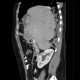 Diaphragmatic hernia, Morgagni hernia: CT - Computed tomography