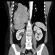 Diaphragmatic hernia, Morgagni hernia: CT - Computed tomography