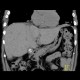 Diaphragmatic hernia, Morgagni hernia: CT - Computed tomography