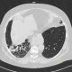 Bronchiectasia, HRCT: CT - Computed tomography