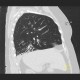 Bronchiectasia, HRCT: CT - Computed tomography