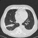 Bronchoinvasive aspergilosis: CT - Computed tomography