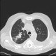 Bronchoinvasive aspergilosis: CT - Computed tomography