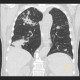 Bronchoinvasive aspergilosis: CT - Computed tomography