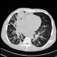 Bronchopneumonia, tree-in-bud: CT - Computed tomography