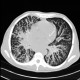 Bronchopneumonia, tree-in-bud: CT - Computed tomography