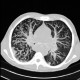 Bronchopneumonia, tree-in-bud: CT - Computed tomography