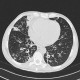 Bronchopneumonia, tree-in-bud: CT - Computed tomography