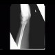 Barton fracture: X-ray - Plain radiograph