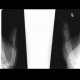 Bennett's fracture: X-ray - Plain radiograph